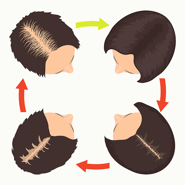 Fázy vypadávania vlasov u žien, zväčšujúca sa vlasová cestička